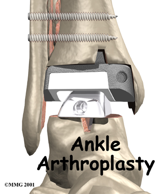 Artificial Joint Replacement of the Ankle