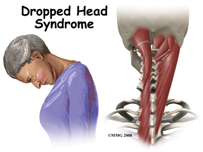 Dropped Head Syndrome