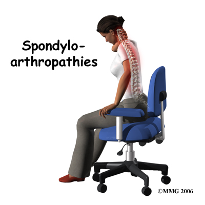 Spondyloarthropathies